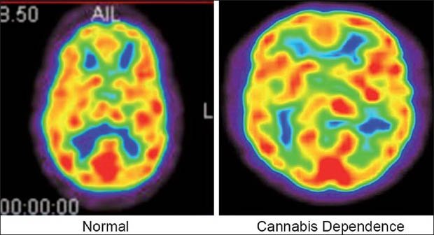 科學家研究長期吸食大麻者，腦體積膨脹，損害大腦。(圖片來源：whattododigital)