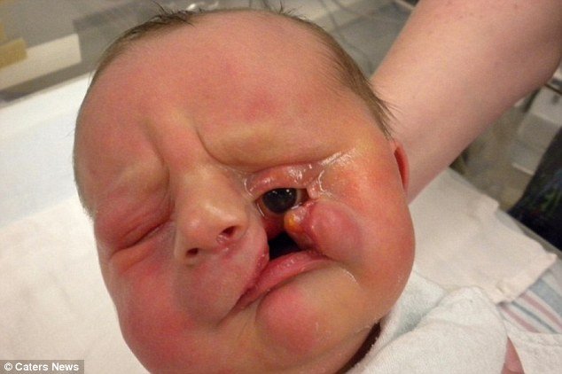伊森一出生就患有嚴重的顏面裂症狀。(圖片來源：http://www.dailymail.co.uk/)