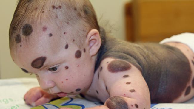 狄倫一出生就患有罕見先天性巨大型黑色素痣 。(圖片來源：http://www.news.com.au/)