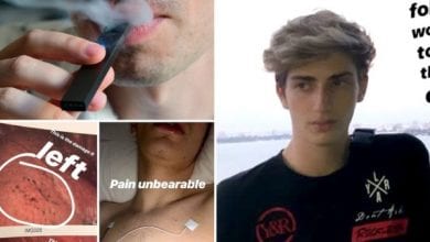 Photo of 美18歲男吸電子菸肺塌陷出現許多小黑點　聯合國：已造成公眾健康危機