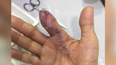Photo of 洗蝦被刺傷！男食指被「食肉菌」啃蝕截肢　再晚1天就沒命